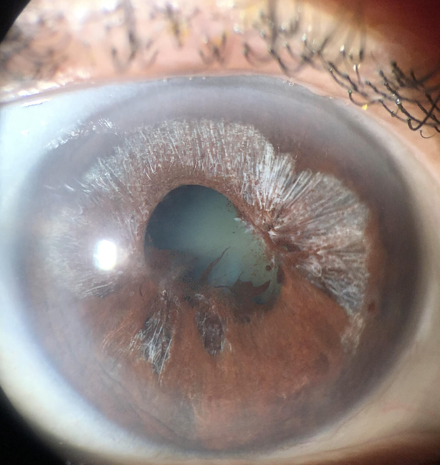 Herpes Ocular
